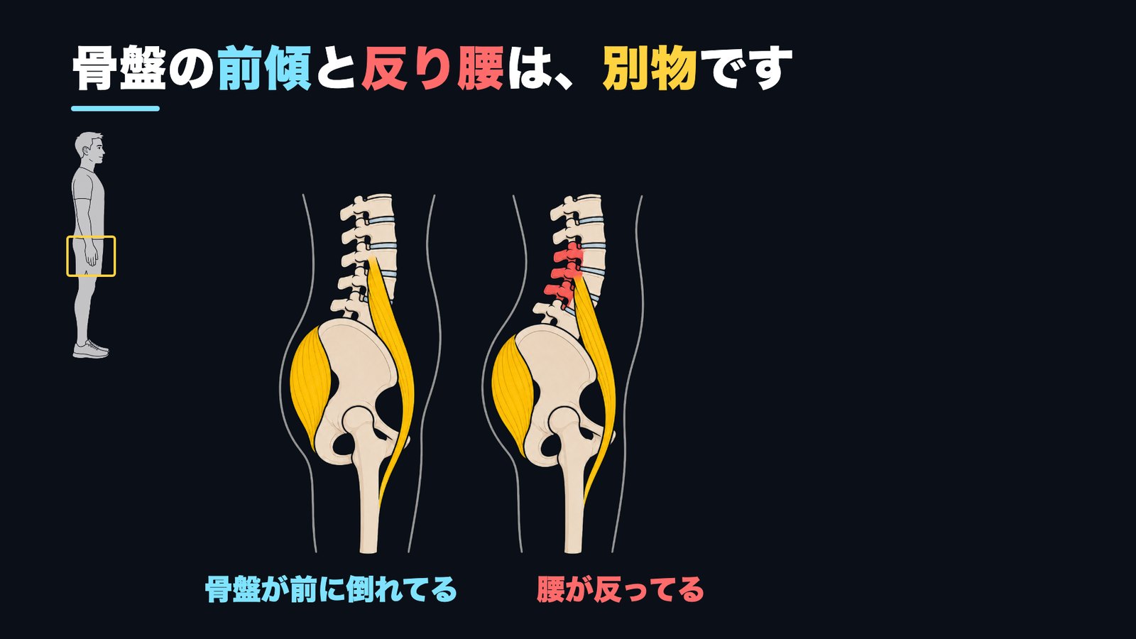 反り腰と骨盤前傾の違い 腰が反っている比較図